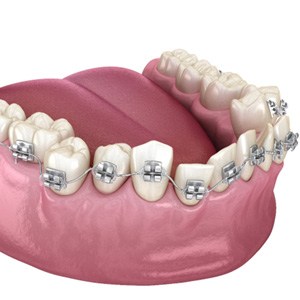 3D illustration for cost of traditional braces in Enfield  ? 