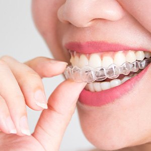 Spark trays are more discreet than traditional braces