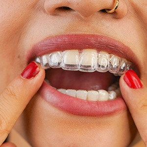 Spark trays are more comfortable than traditional braces