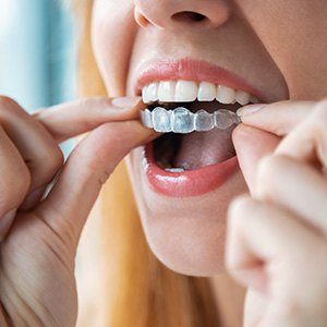 A young woman placing an Invisalign aligner over her teeth