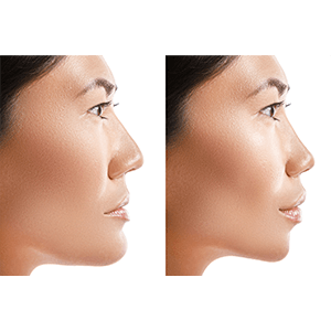 a before and after of a woman’s jaw position